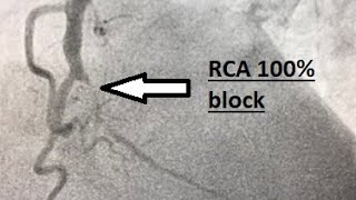 Right coronary artery 100 blocked 100 RCA blocked Chronic total occlusion CTO [upl. by Moskow656]