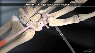 Arthrex CMC Ligament Reconstruction [upl. by Alyn274]