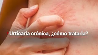 COMEZÓN POR TODAS PARTES  ¿Qué puede provocar la urticaria crónica y cómo tratarla [upl. by Uba]