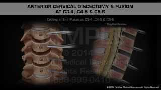 Anterior Cervical Discectomy amp Fusion at C34 C45 amp C56 [upl. by Ajnek888]