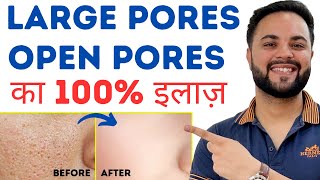 Open Pores Large Pores Clogged Pores Permanent Treatment [upl. by Johan]