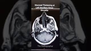 Mucosal Thickening at Left Maxillary Sinus Sinusitis  sinusitis mri ct [upl. by Swane942]