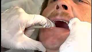 Complete Denture Procedure  20 INITIAL PLACEMENT OF THE DENTURES [upl. by Nayt]