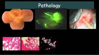 Bilateral Exudative retinal detachment with subretinal exudates Dr E M Dodds [upl. by Stefa]