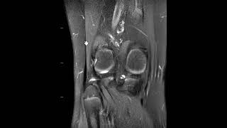 Fibular avulsion fracture at conjoined tendon insertion [upl. by Lunna]