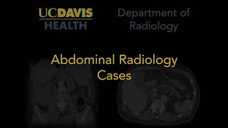 Prostatitis on CT [upl. by Baras989]