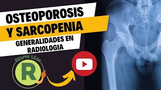 Osteoporosis y sarcopenia generalidades en Radiología e Imagen [upl. by Michaele]