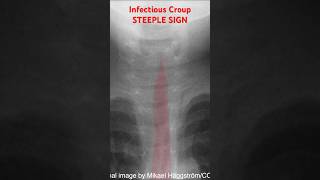 Infectious Croup Xray Steeple Sign [upl. by Angrist288]