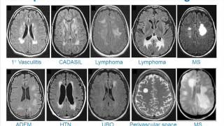 MRI Uses in MS [upl. by Venice]