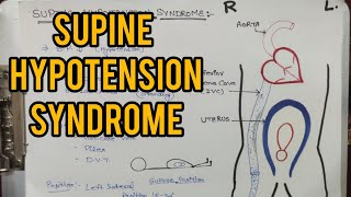 Supine Hypotension syndrome  Femoral vein Pressure  Position during pregnancy [upl. by Kazue835]