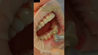 Carillas de resina como quedan dientes esteticadental dientesblancos [upl. by Anitroc]