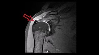 Shoulder MRI Calcific Tendinitis [upl. by Stortz114]