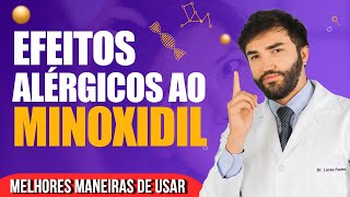 Tudo sobre ALERGIA e efeitos colaterais do MINOXIDIL [upl. by Zulaledairam57]