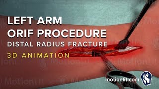 Left Arm ORIF Procedure of Distal Radius Fracture  3D Medical Animation [upl. by Asilana92]