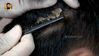 Scalp Psoriasis Scratching Black Hair Dandruff Removal ​308 [upl. by Eliott]