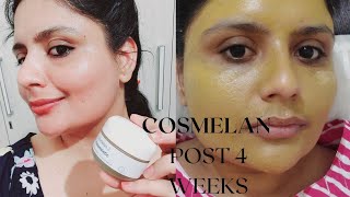 Cosmelan Peel indian skin journey pigmentation skincare aesthetic antiaging [upl. by Eelesor]