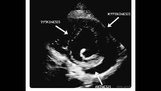 Hypokinesia Dyskinesia and Akinesia in a Single Echocardiography Frame [upl. by Onra]