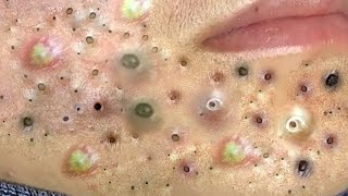 Big Cystic Acne Blackheads Extraction Blackheads amp Milia Whiteheads Removal Pimple Popping  5370 [upl. by Netsirhk]