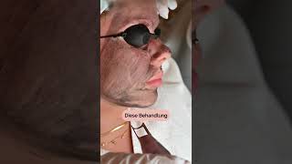 Carbon Peeling mit Laser in Wien  Hollywood Peeling [upl. by Ahsirkal]