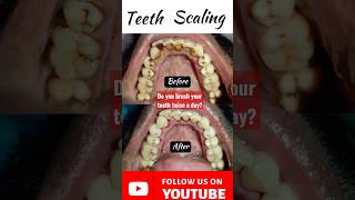 🇳🇵Brush your teeth daily Dental Scaling Tartar Cleaning Deep cleaning Kathmandu Dentist Dr Dentalk [upl. by Abibah]