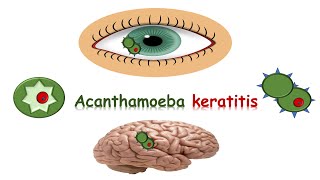 شرح Acanthamoeba keratitis [upl. by Animehliw408]