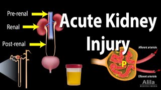 Acute Kidney Injury aka Acute Renal Failure Animation [upl. by Haneekas999]