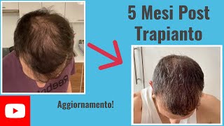 Aggiornamento 5 mesi post trapianto di capelli [upl. by Betthezel]