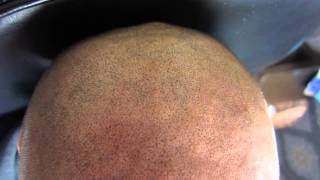 Impressie Micro Hair Pigmentation MHP behandeling bij Beauty Care Nederland BCN te Katwijk [upl. by Retxab]