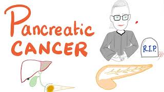 Pancreatic Cancer  Risk Factors Symptoms Signs Diagnosis Management [upl. by Dove737]