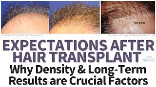 Hair Transplant Expectations Limitations LongTerm Results and an Alternative for Thinning Hair [upl. by Shayna]