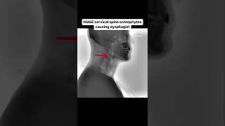 HUGE cervical spine osteophytes causing dysphagia [upl. by Aken51]