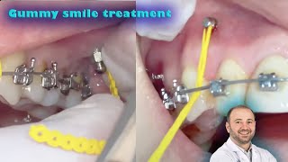 TADsmini implants to correct the gummy smile without surgery and to fix sever deep bite amp class 2 [upl. by Arutnev580]