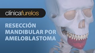 Resección mandibular por ameloblastoma 01 [upl. by Kowal]