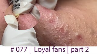 Acne Treatment Huong Da Nang 077  Loyal fans  part 2 [upl. by Annua]