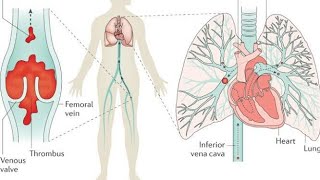 pulmonary thromboembolism1 [upl. by Notsecnirp]