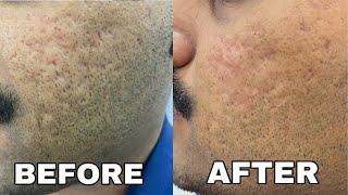 Instant results for ACNE SCARS  Fillers for acne scars  Dr Thaj [upl. by Ayeka620]