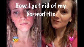 How I Cured My Perioral Dermatitis [upl. by Rosaline]