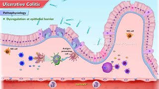 Ulcerative Colitis Animation  Etiology Clinical features Pathophysiology Diagnosis Treatment [upl. by Rycca845]