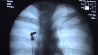 Barium Swallow Video [upl. by Yehus51]