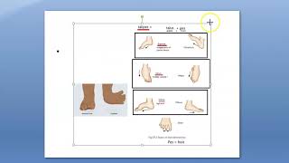 Orthopedics CTEV Congenital Talipus Equino Varus Cavus Club Foot Terminology Name Define Definition [upl. by Felske]