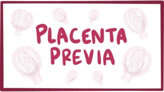 Placenta previa  causes symptoms diagnosis treatment pathology [upl. by Mattah626]