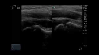 PointofCare Ultrasound for Hip Effusion [upl. by Itsyrc]