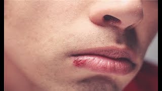 how to get rid of cold sores in 1 hour [upl. by Jaco58]