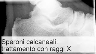 Radioterapia per sperone calcaneare caratteristiche e principi di trattamento [upl. by Khalin]