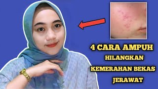 4 Tips Cara Menghilangkan Kemerahan Bekas Jerawat Di Wajah Secara Cepat🦋 [upl. by Annoed308]