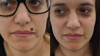 Facial mole removal demo  large mole removed from upper lip  fast and pain free [upl. by Annoirb]