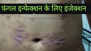 fangal infection in hindi [upl. by Marje]