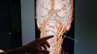 Brain Fog and Tinnitus from Anterior Atlas Subluxation [upl. by Dami633]