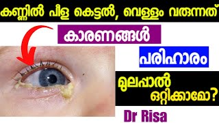 കുഞ്ഞിന്റെ കണ്ണിലെ പഴുപ്പ്Eye Discharge In Babies MalayalamHome remedy for Watery Eyes [upl. by Eeniffar]