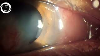 Pedicle conjunctival flap for infectious Keratitis [upl. by Knorring]